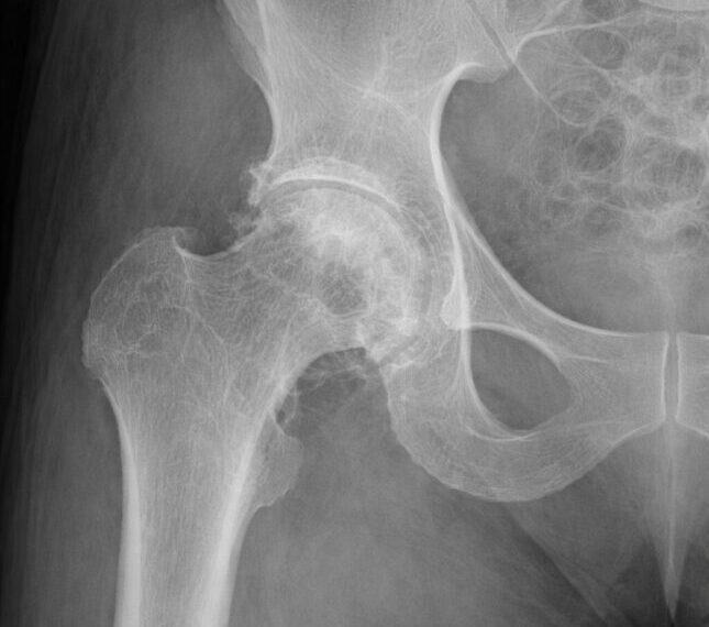 Рентгеновский снимок тазобедренного сустава с признаками остеоартрита.