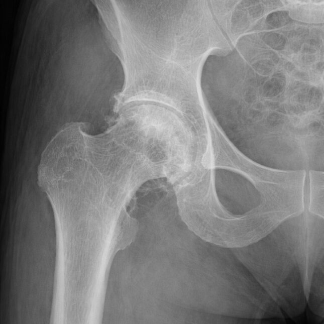 Рентгеновский снимок тазобедренного сустава с признаками остеоартрита.