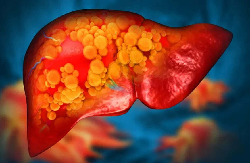 Жировой гепатоз печени, изображение органа с жировыми отложениями.