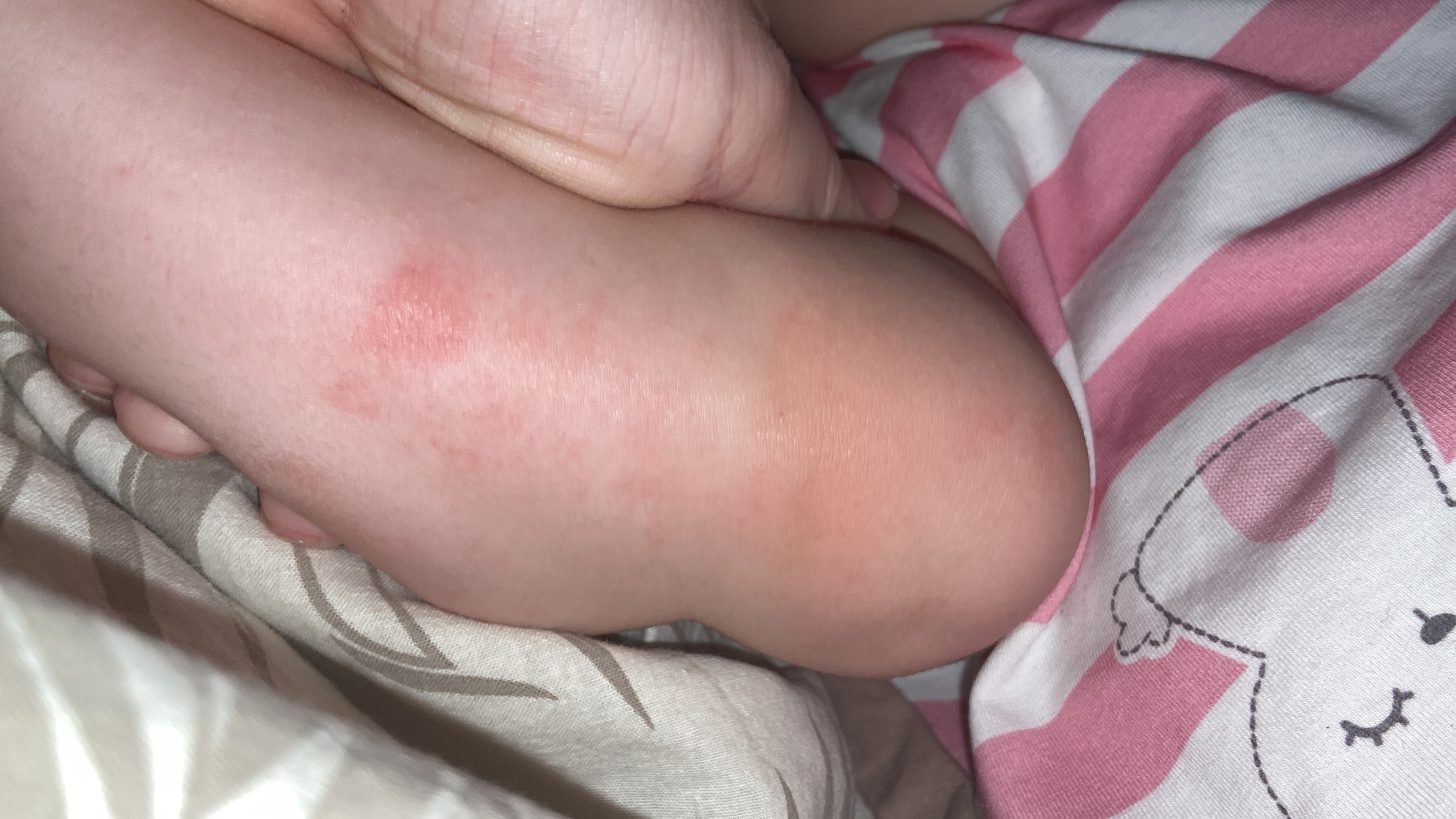  покраснение на писи у дочки 