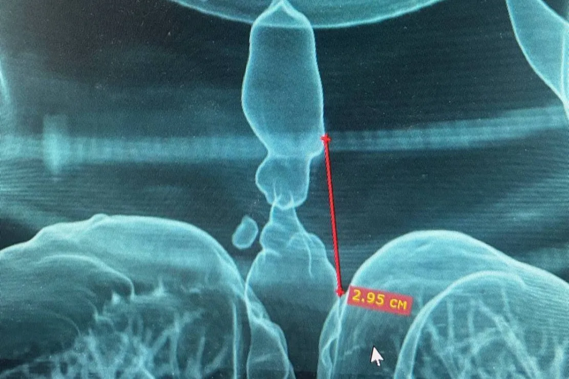 Врачи Удмуртии спасли от гибели пациентку при помощи 3D-технологий