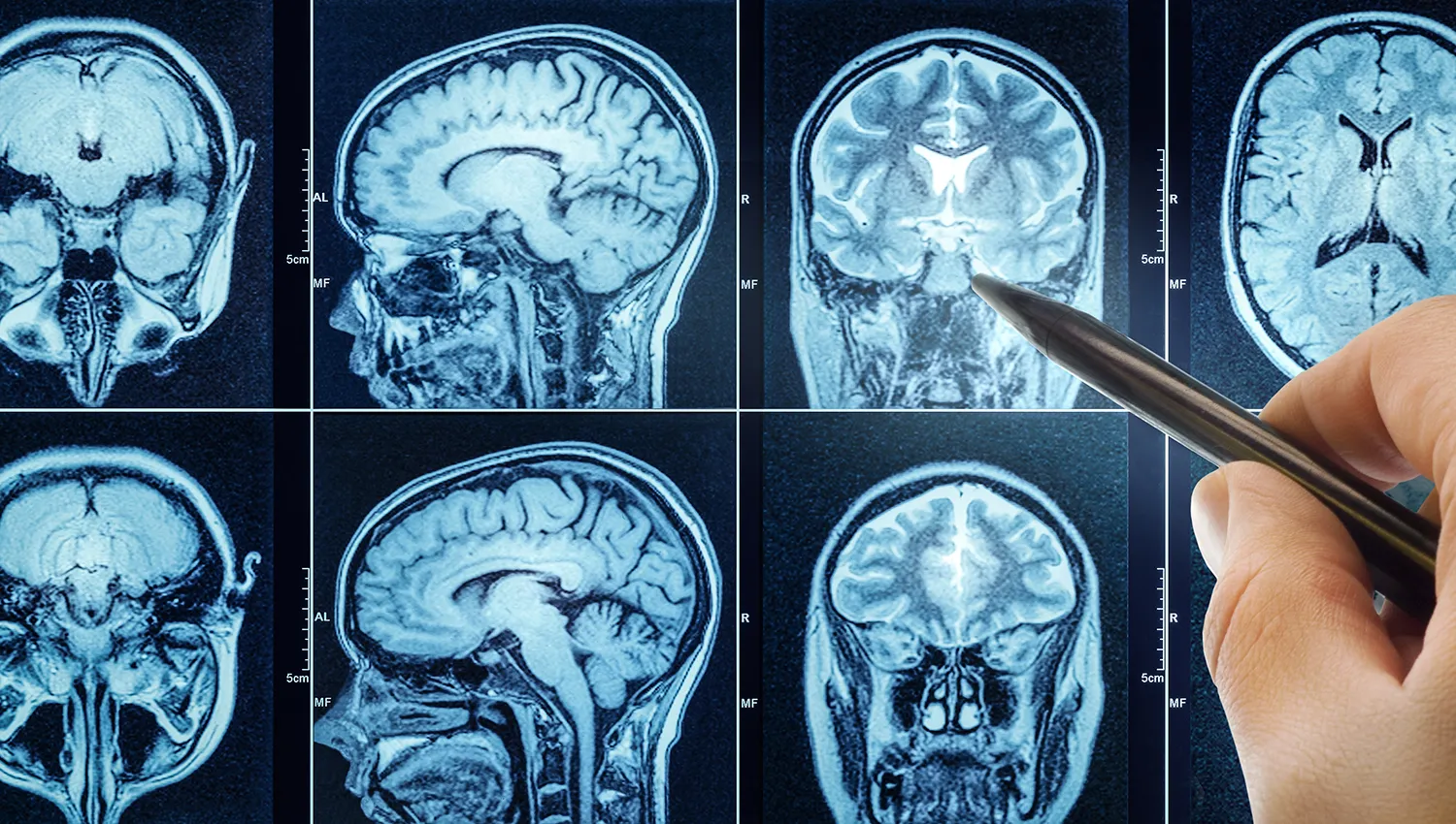 Photo - Artificial Intelligence to the Rescue: Russia Tackles Dementia with Early Diagnostics