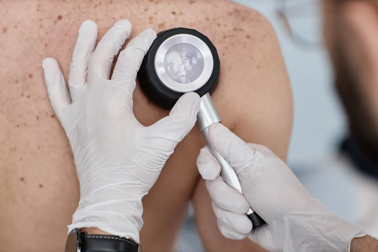 Russia Develops Remote Screening System to Detect Melanoma Risk