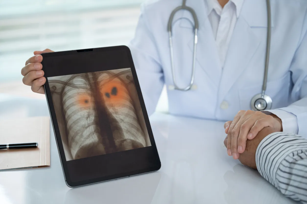 AI Expands Role in Tuberculosis Detection Across Russian Regions