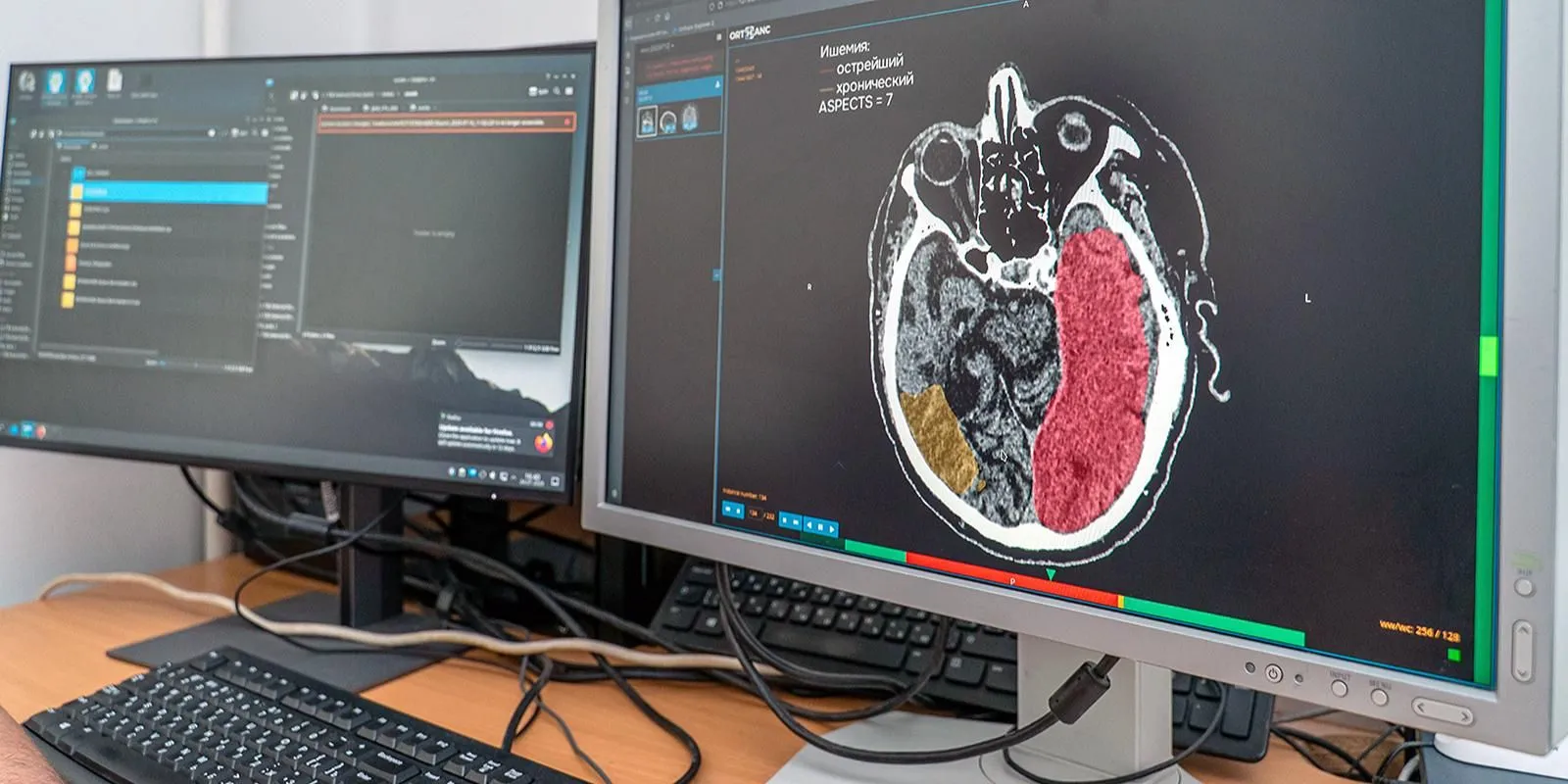 Russia Uses AI to Assist Stroke Treatment in Hospitals