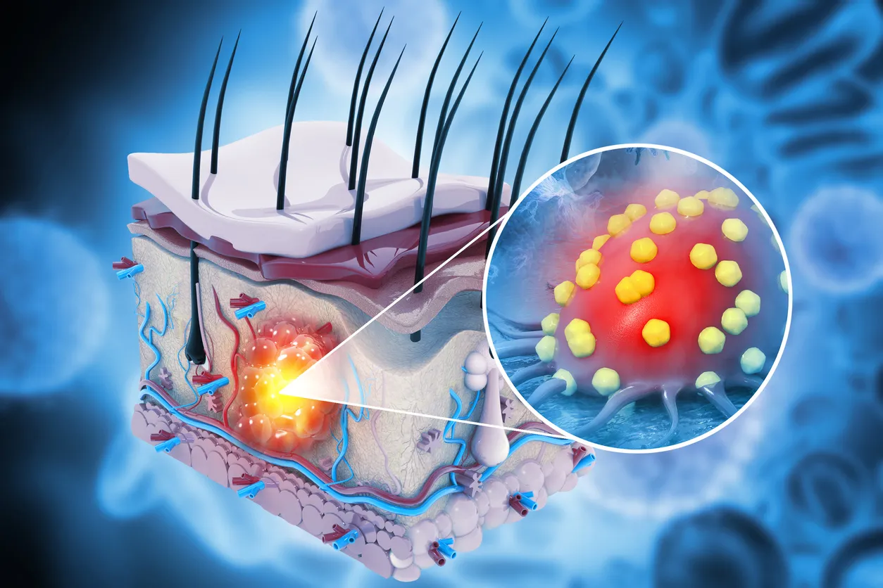 Russia Unveils AI-Powered System for Early Skin Cancer Detection