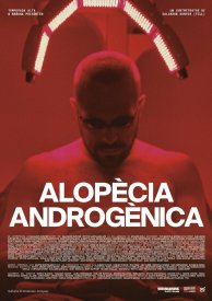 Alopècia androgènica
