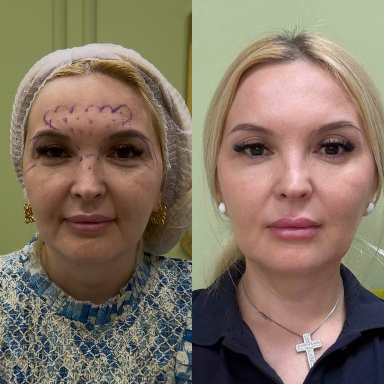 Процедуры аппаратного омоложения кожи в Ставрополе