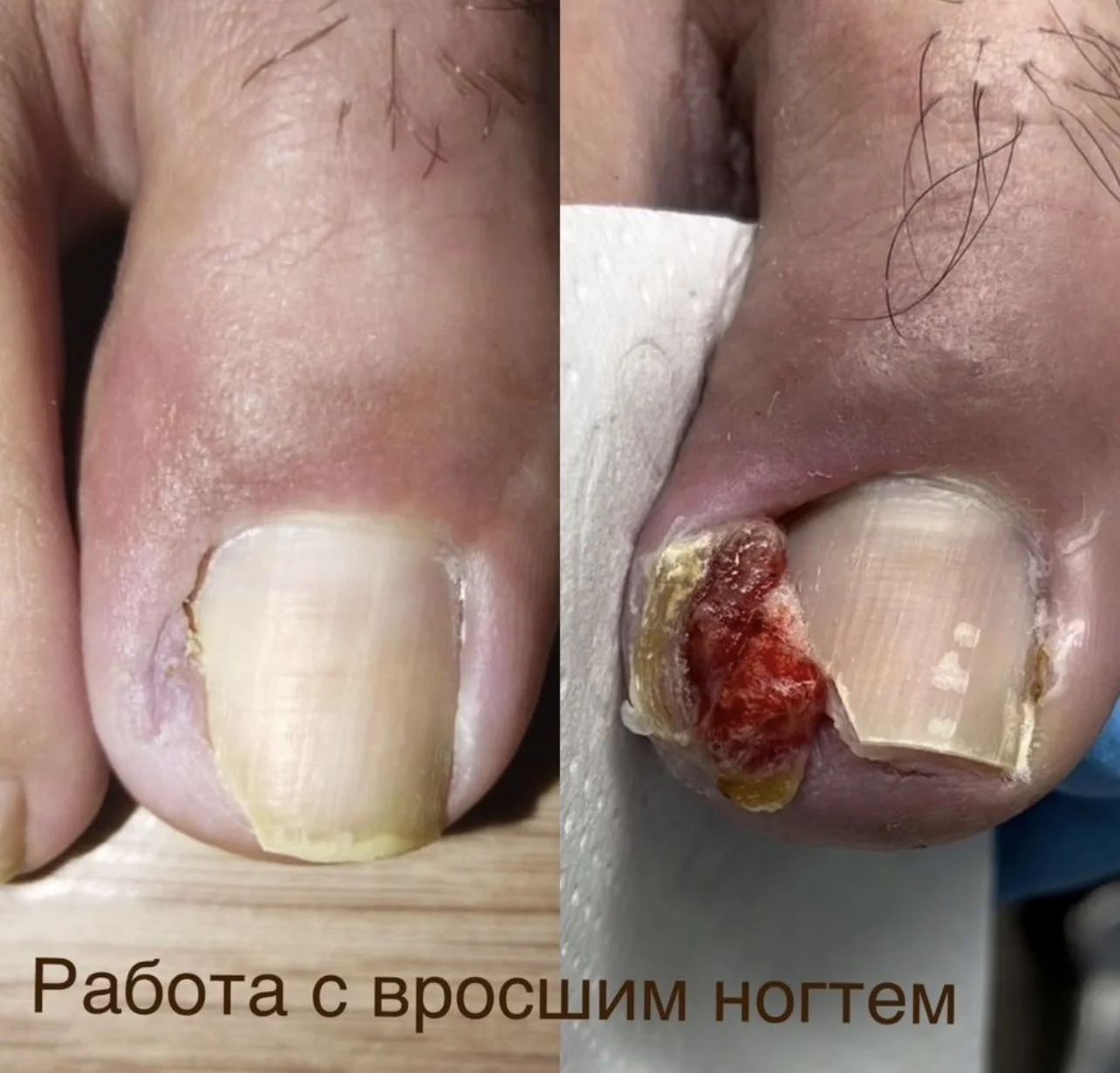 Подолог педикюр выезд на дом - миниатюра 6