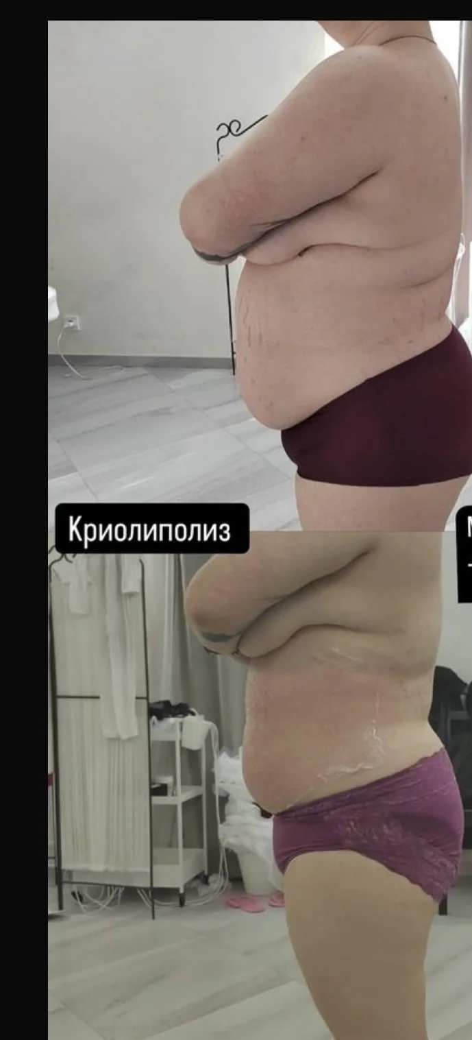 Криолиполиз липосакция - изображение 1