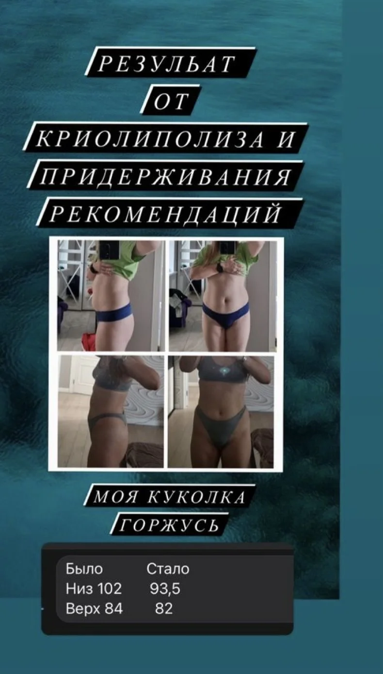 Криолиполиз липосакция - миниатюра 2