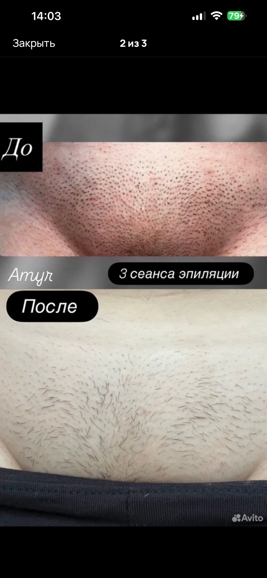 Удаление волос - миниатюра 2