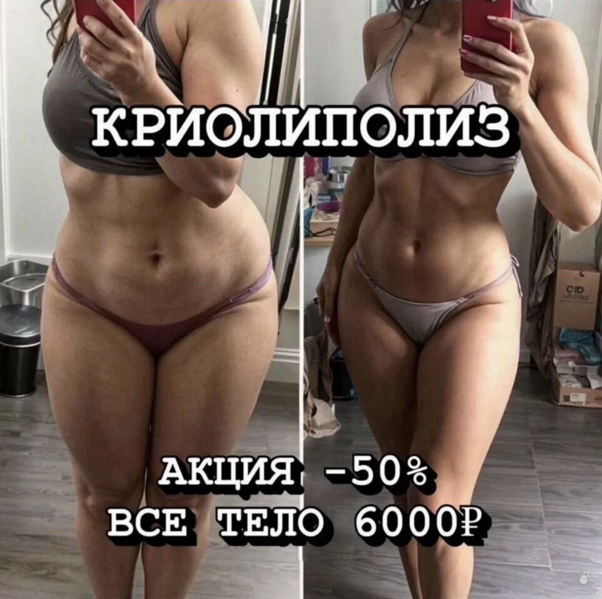 Криолиполиз / аппаратное похудение - изображение 1