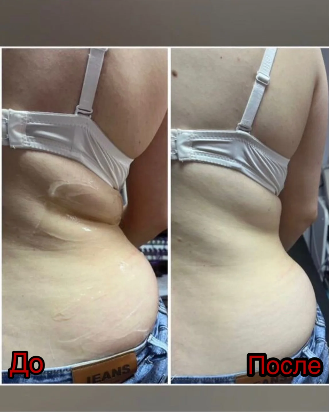 Криолиполиз / аппаратное похудение - миниатюра 4