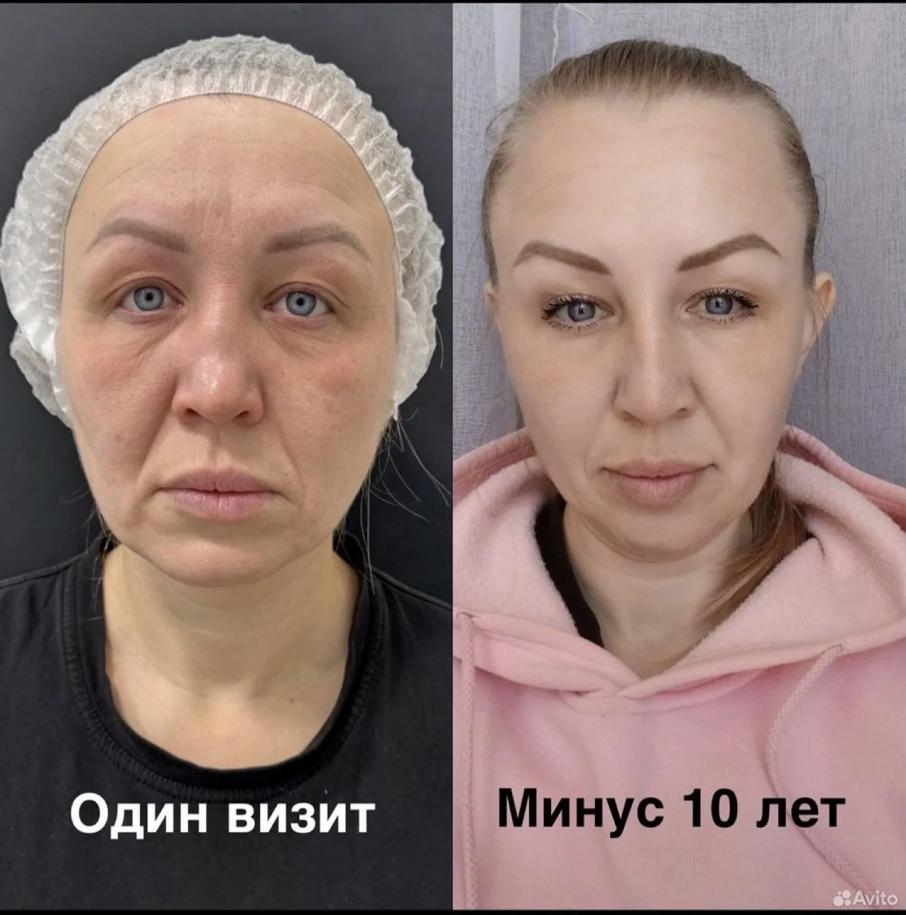 Косметолог Нитевой лифтинг/ нити Cog/Мезонити - миниатюра 6