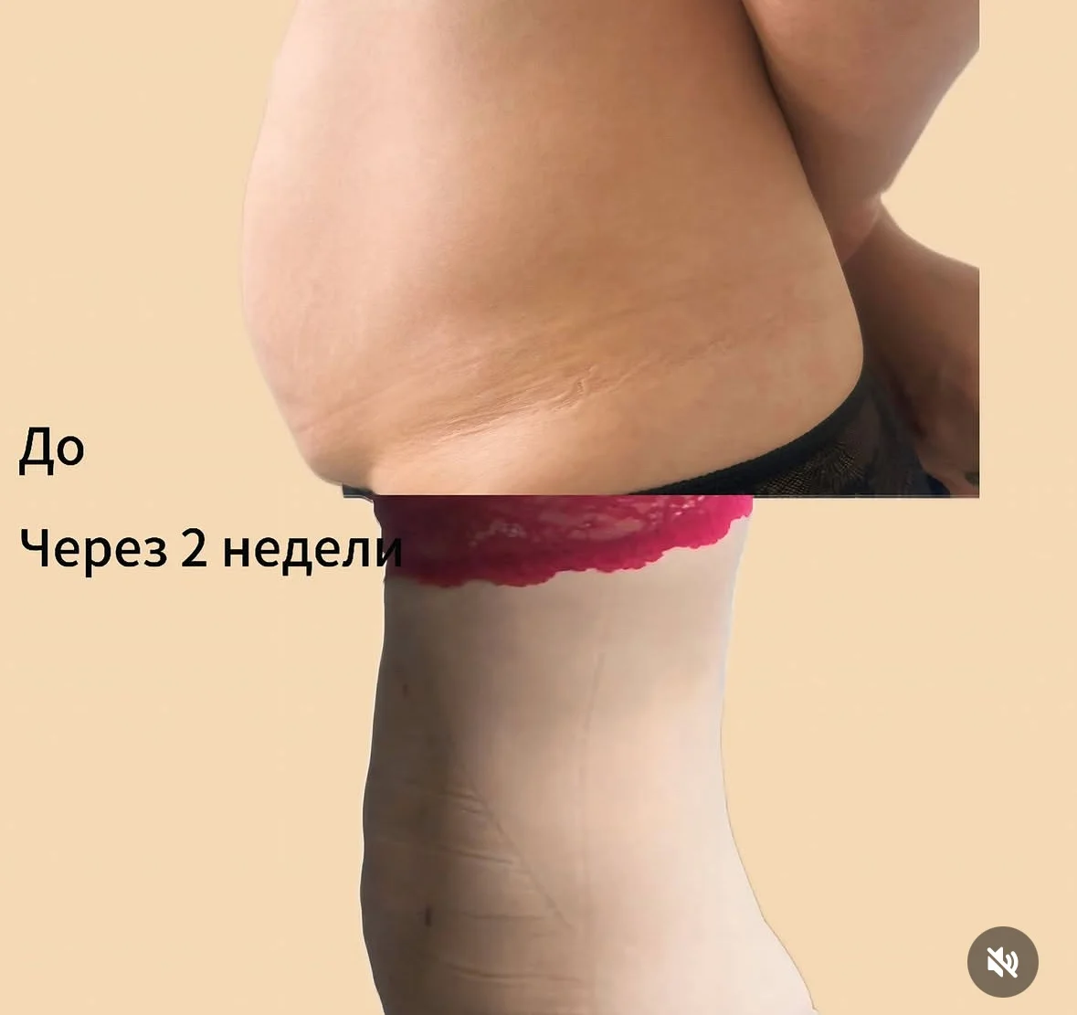 Липосакция - миниатюра 3