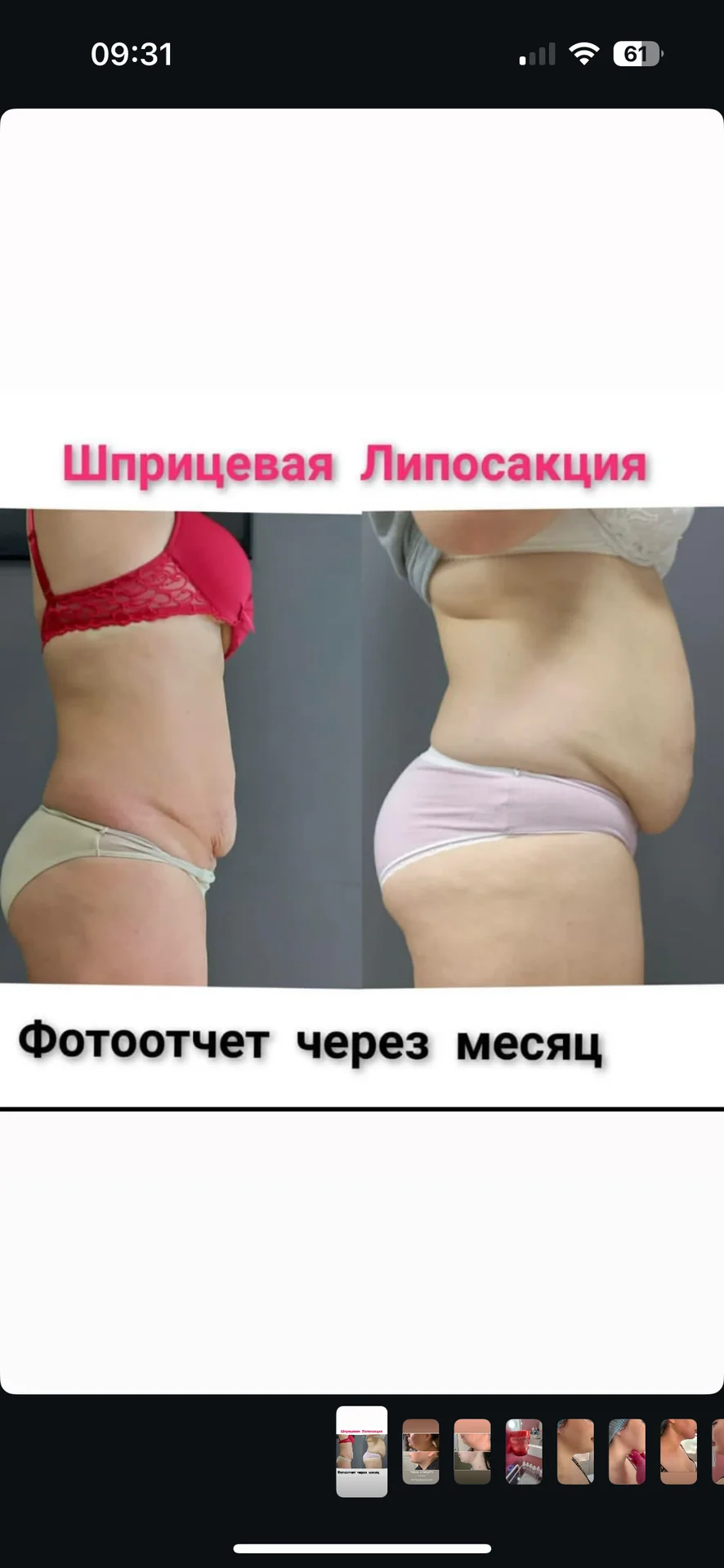 Липосакция - миниатюра 6