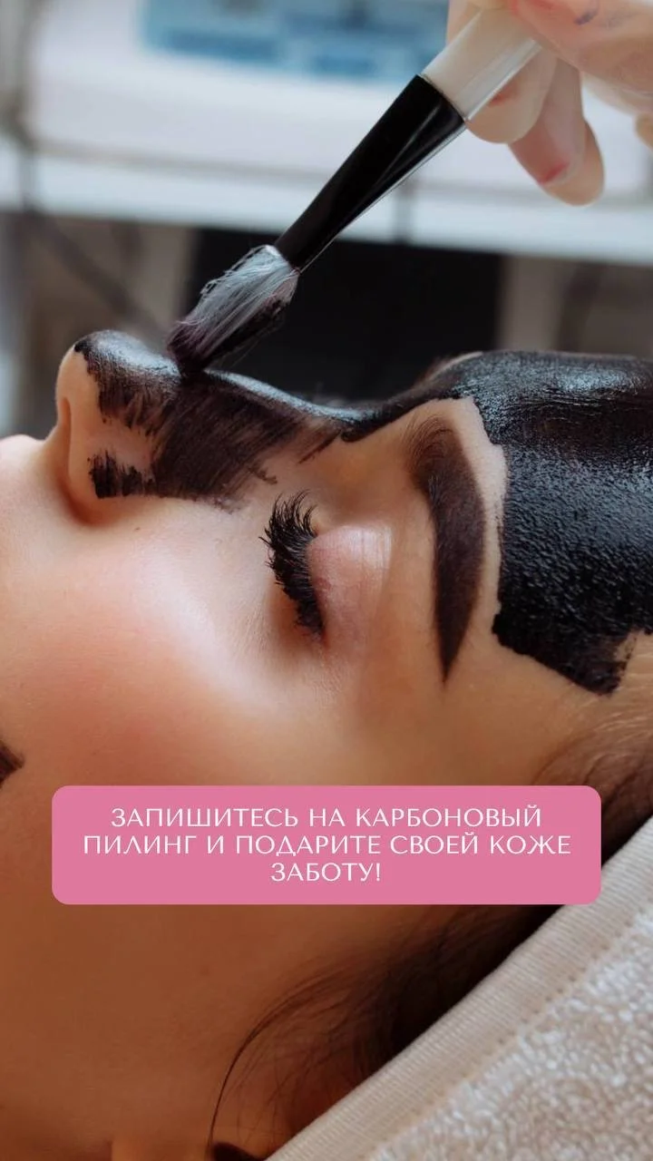 Карбоновый пилинг - изображение 1