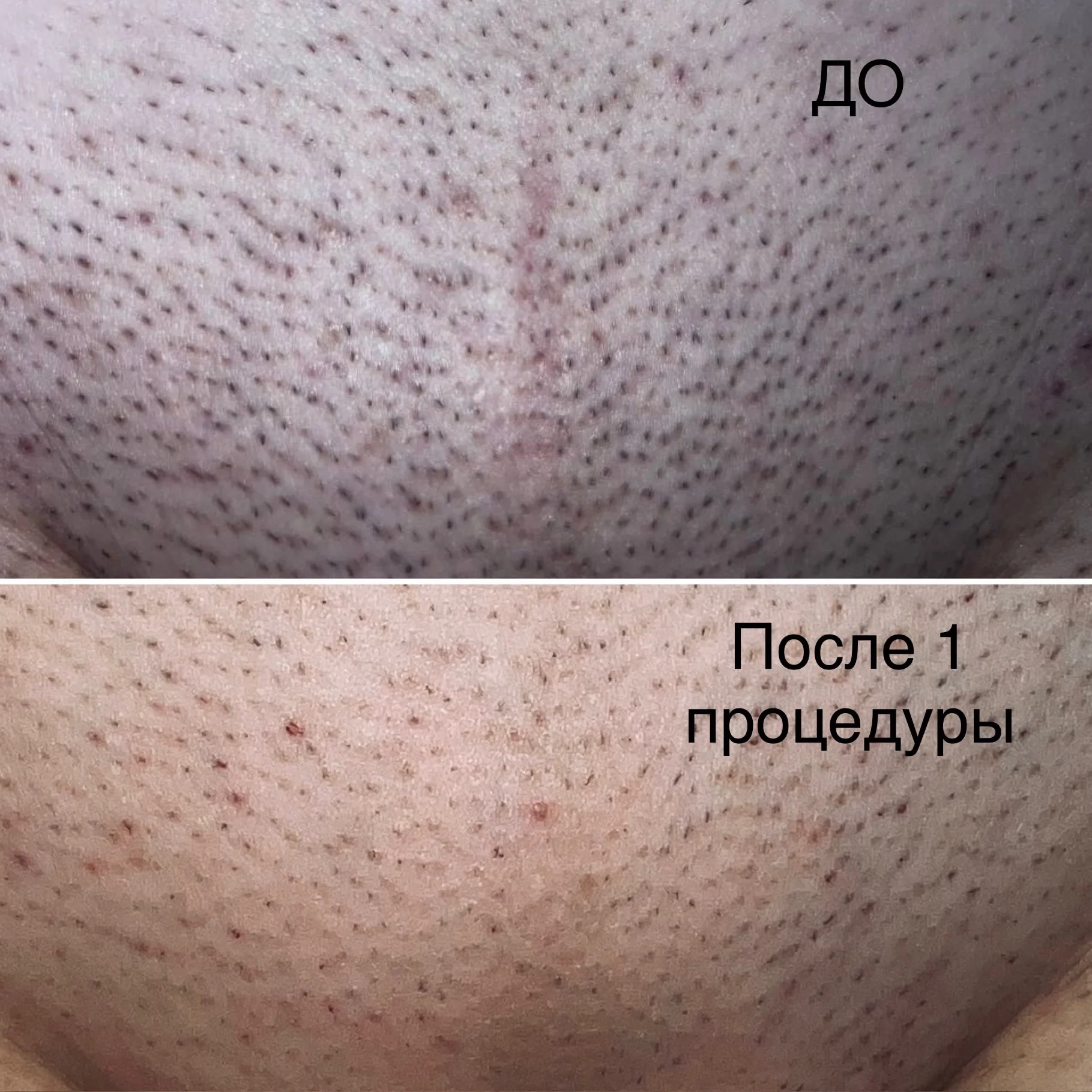 Лазерная эпиляция, диодный лазер - миниатюра 2