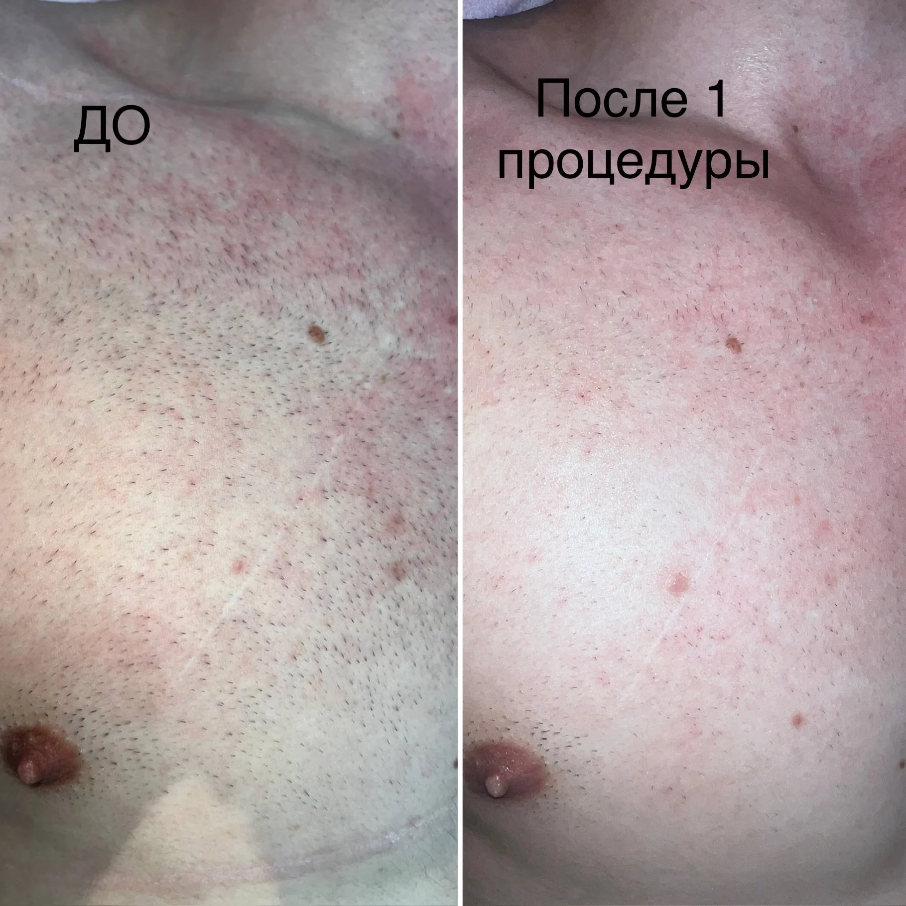 Лазерная эпиляция, диодный лазер - миниатюра 3