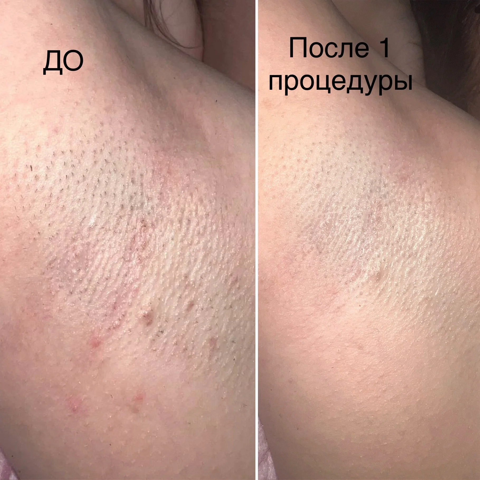 Лазерная эпиляция, диодный лазер - миниатюра 4
