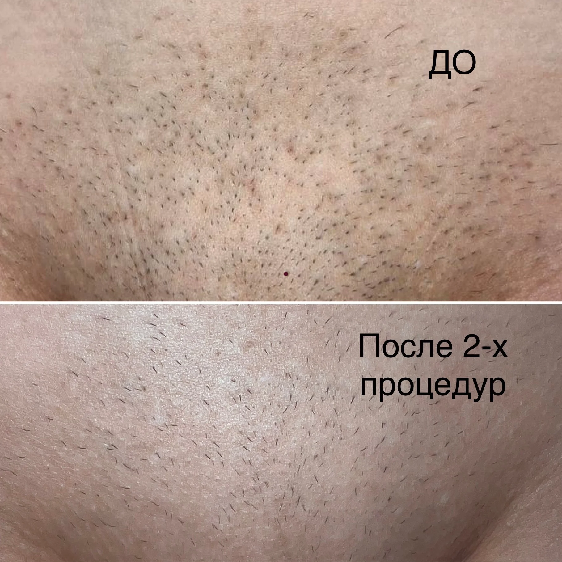 Лазерная эпиляция, диодный лазер - миниатюра 5