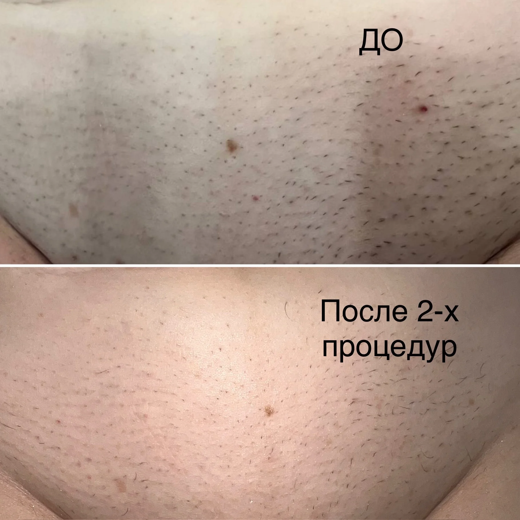 Лазерная эпиляция, диодный лазер - миниатюра 6