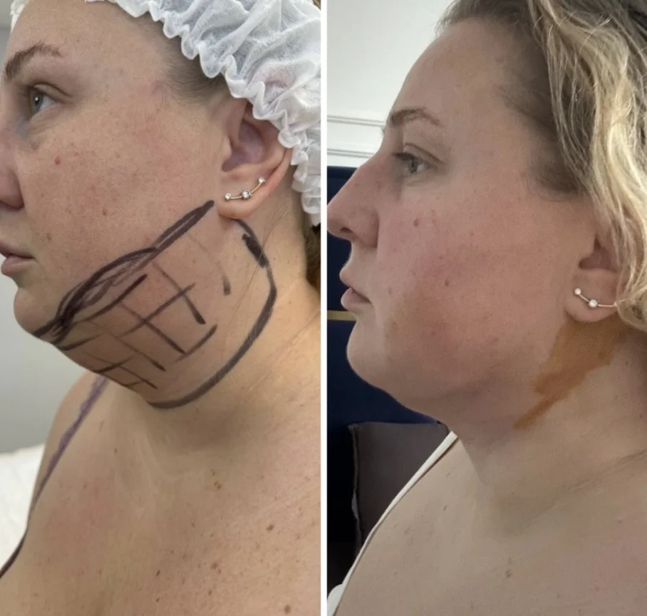 Липоредукция подбородка и холки - миниатюра 5
