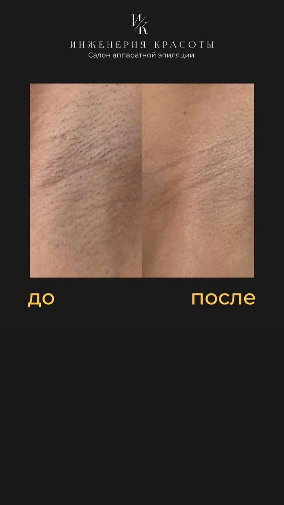 Электроэпиляция Apilus Senior 3g - миниатюра 2