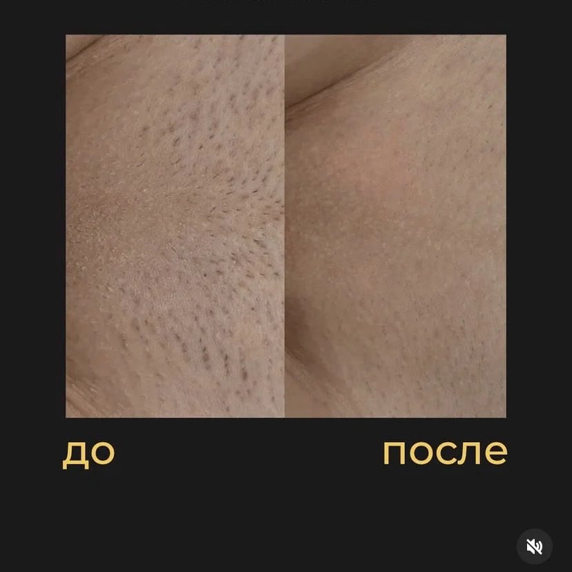 Электроэпиляция Apilus Senior 3g - миниатюра 3
