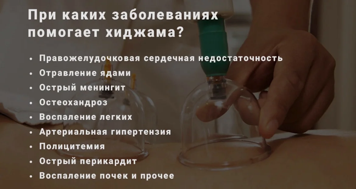 Хиджама - миниатюра 2