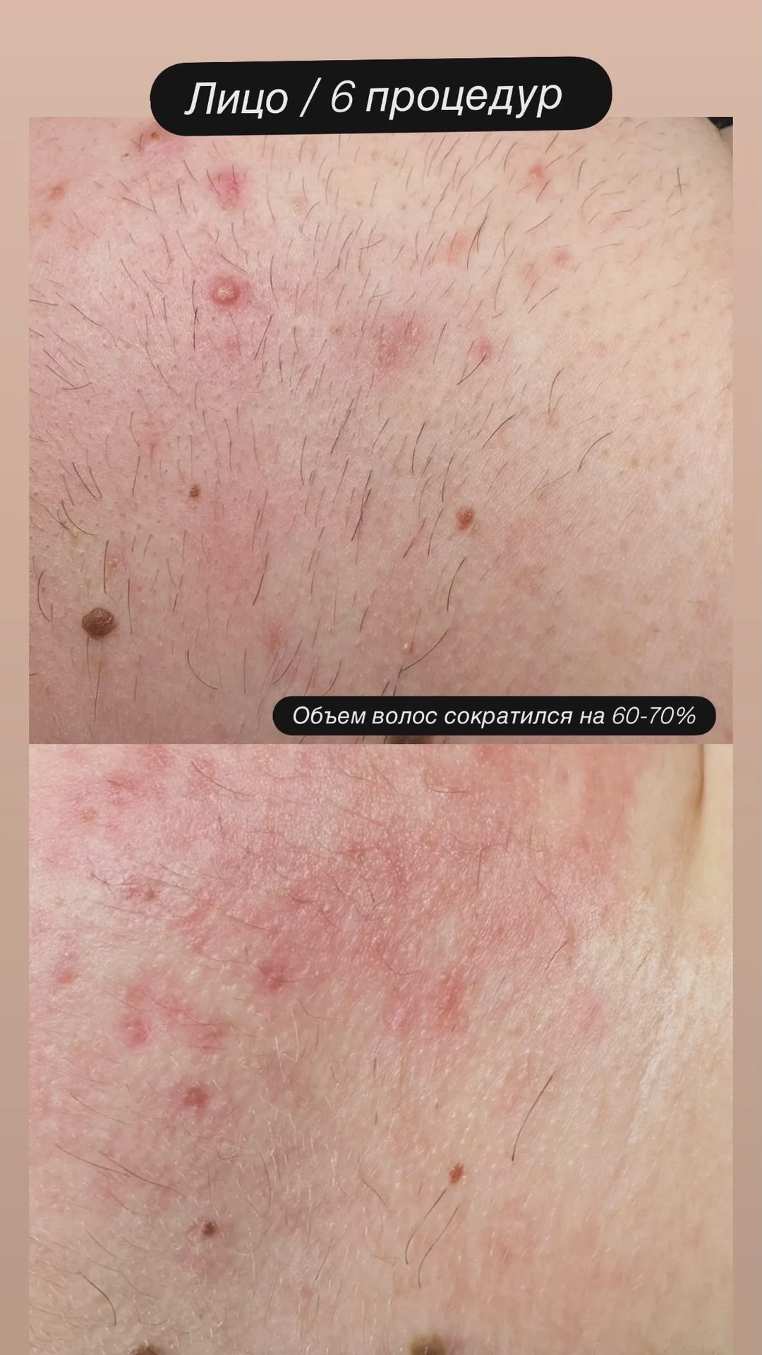 Электроэпиляция - изображение 1