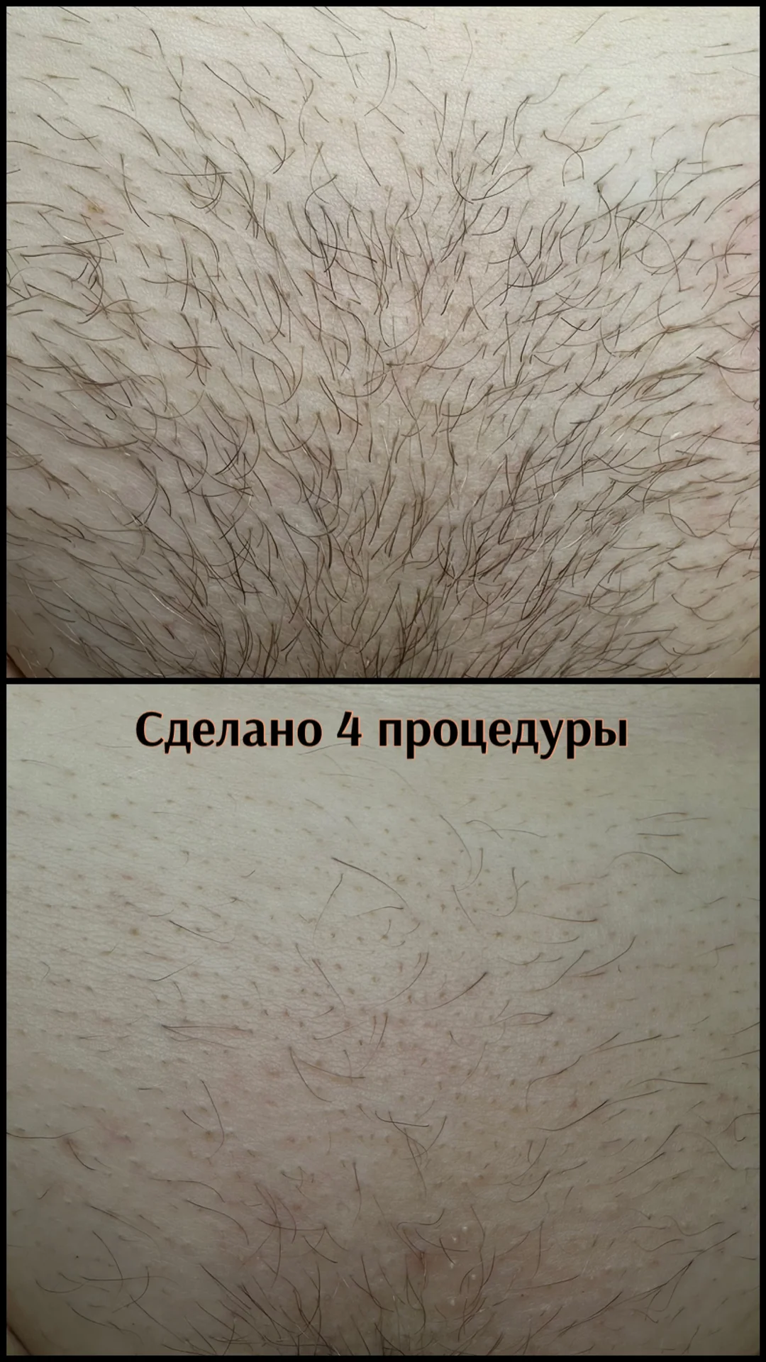 Электроэпиляция - миниатюра 6