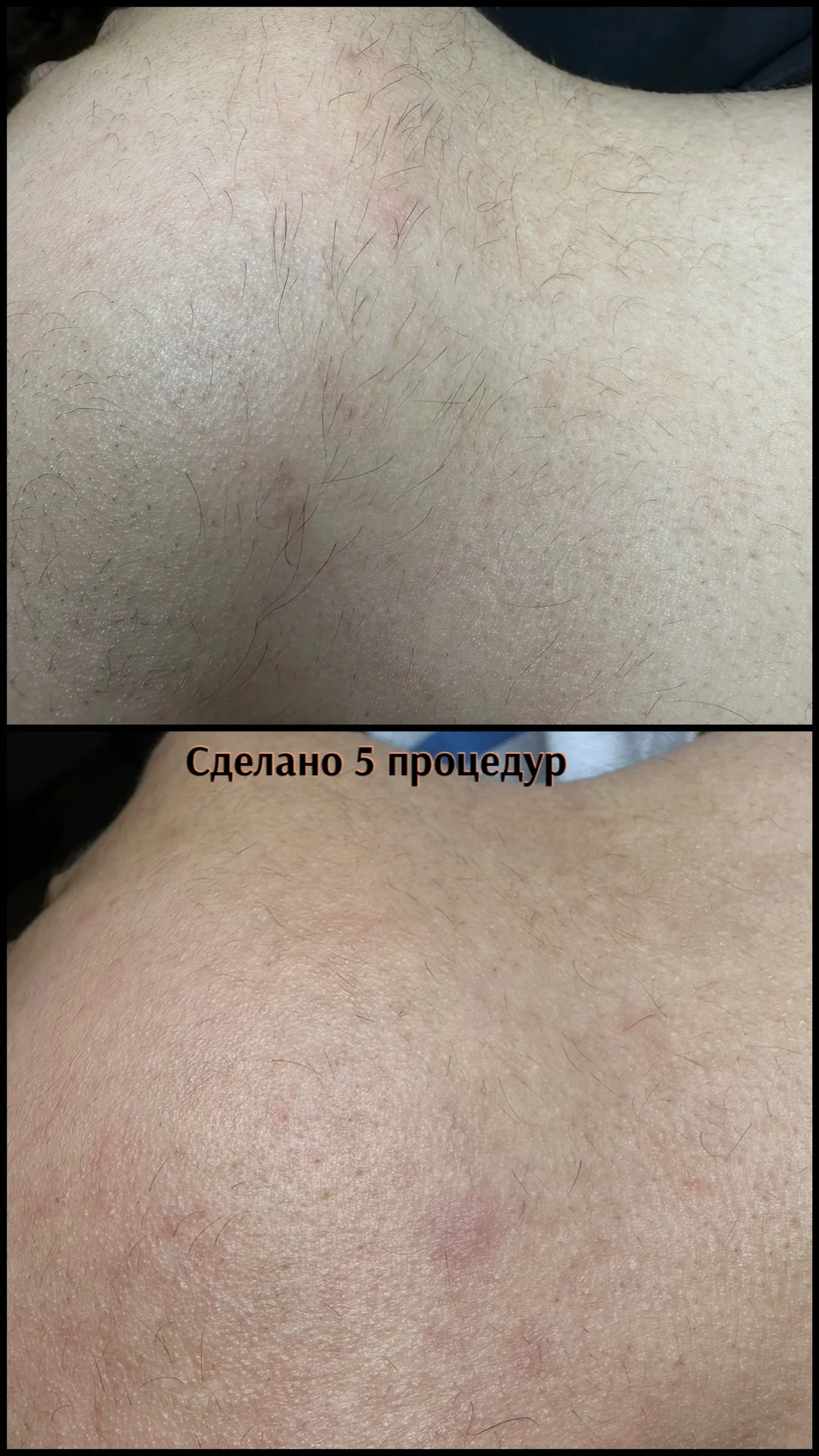Электроэпиляция - миниатюра 7