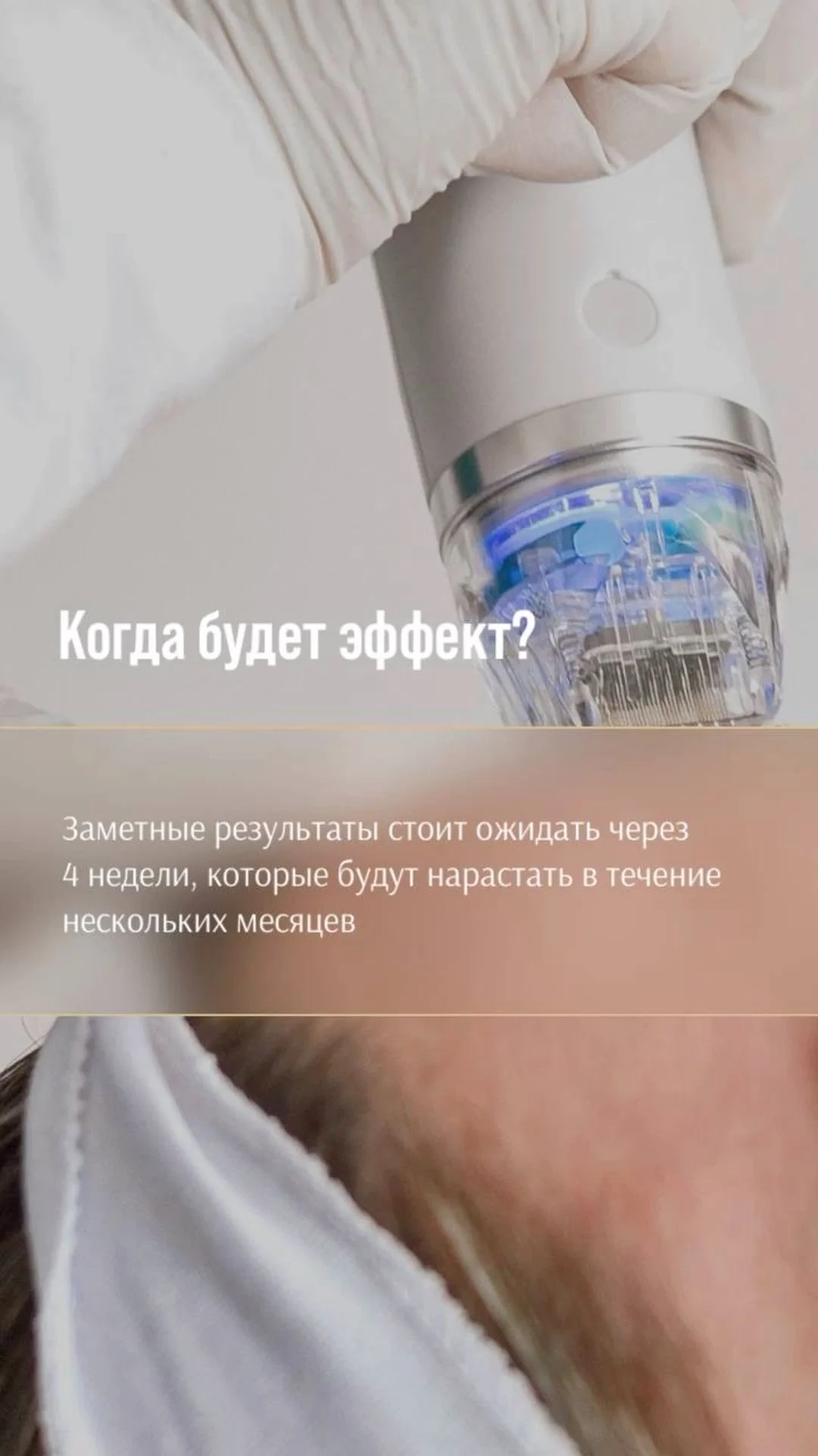 Микроигольчатый рф лифтинг - миниатюра 2