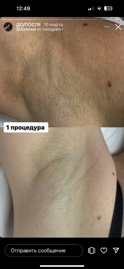 Аппарат для эпиляции с удалением тату - миниатюра 3