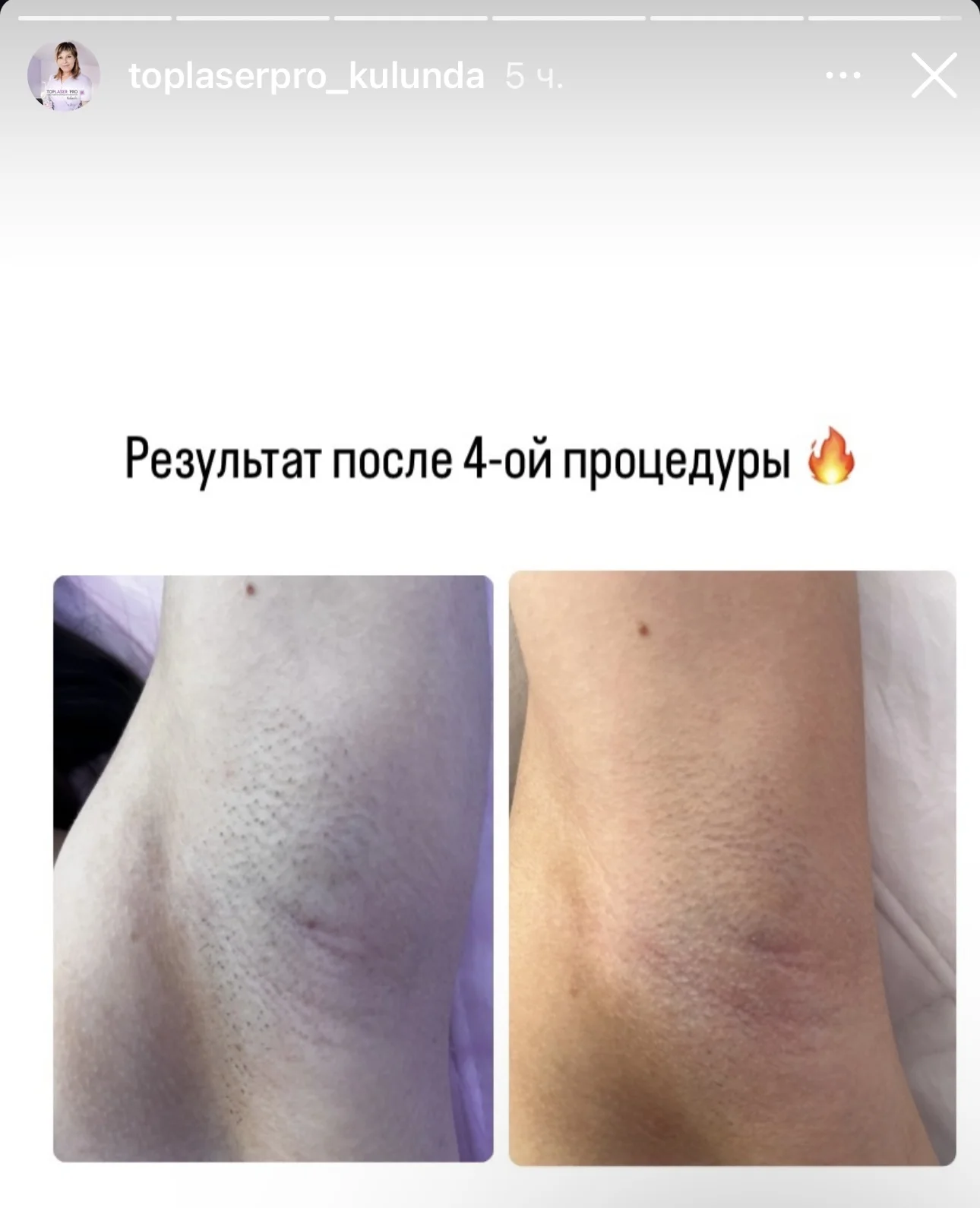 Диодный лазер - миниатюра 6