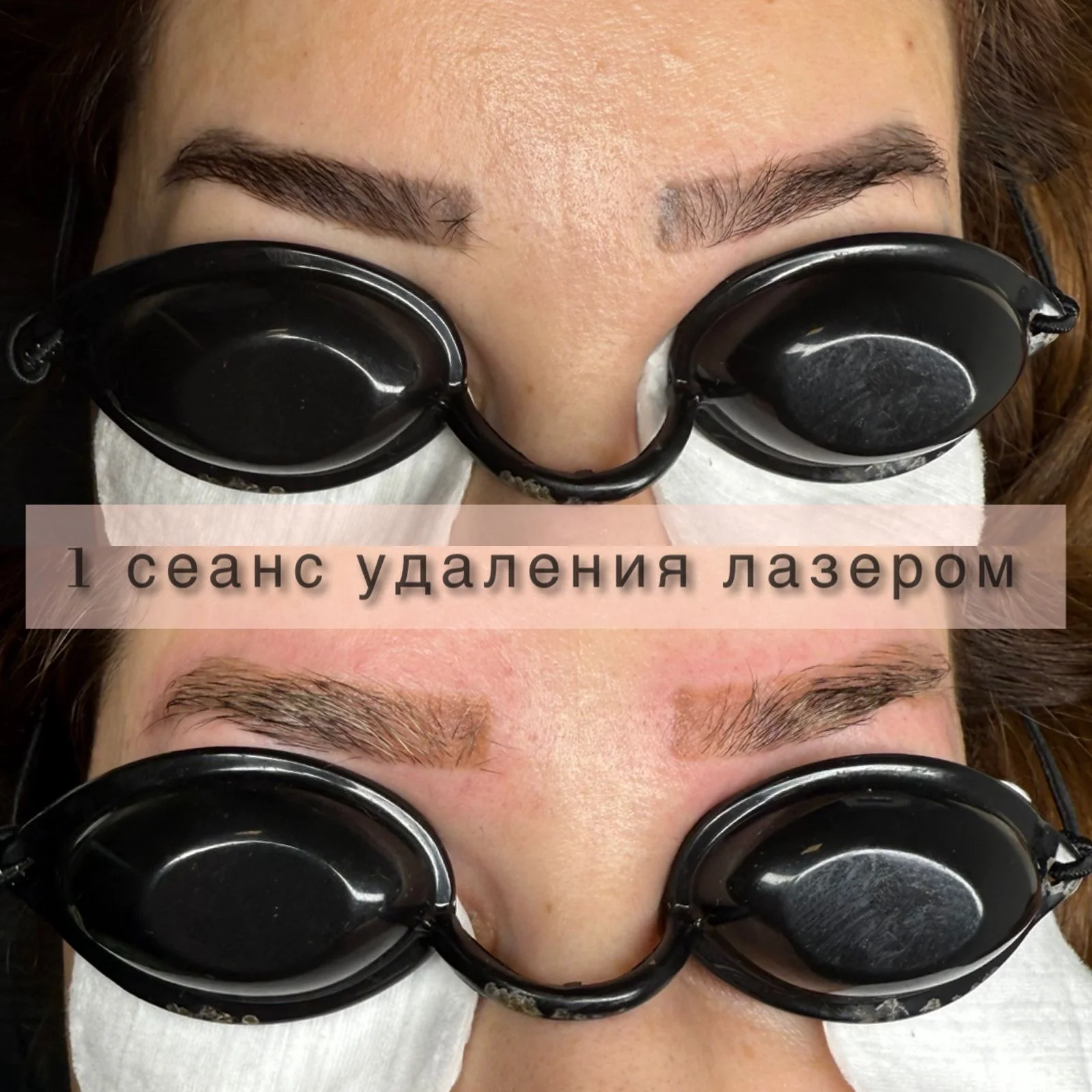 Аппарат косметологический комбайн рф лифтинг ,омоложение ,эпиляция - миниатюра 6