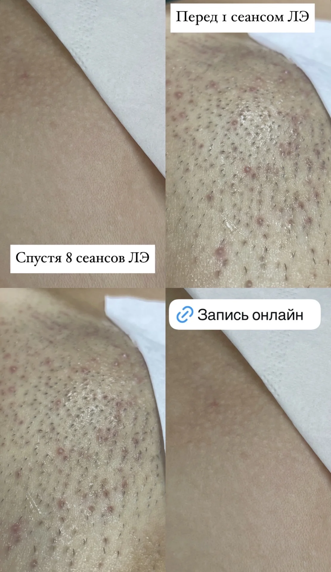 Лазерная и электроэпиляция - миниатюра 2