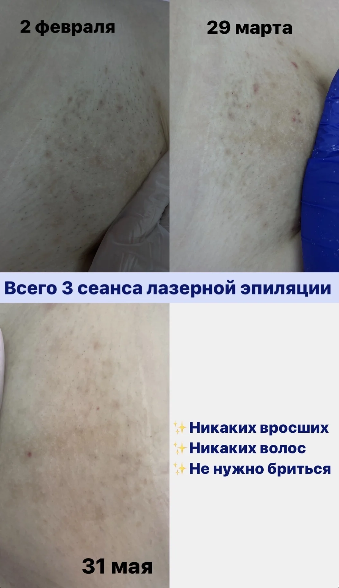 Лазерная и электроэпиляция - миниатюра 3