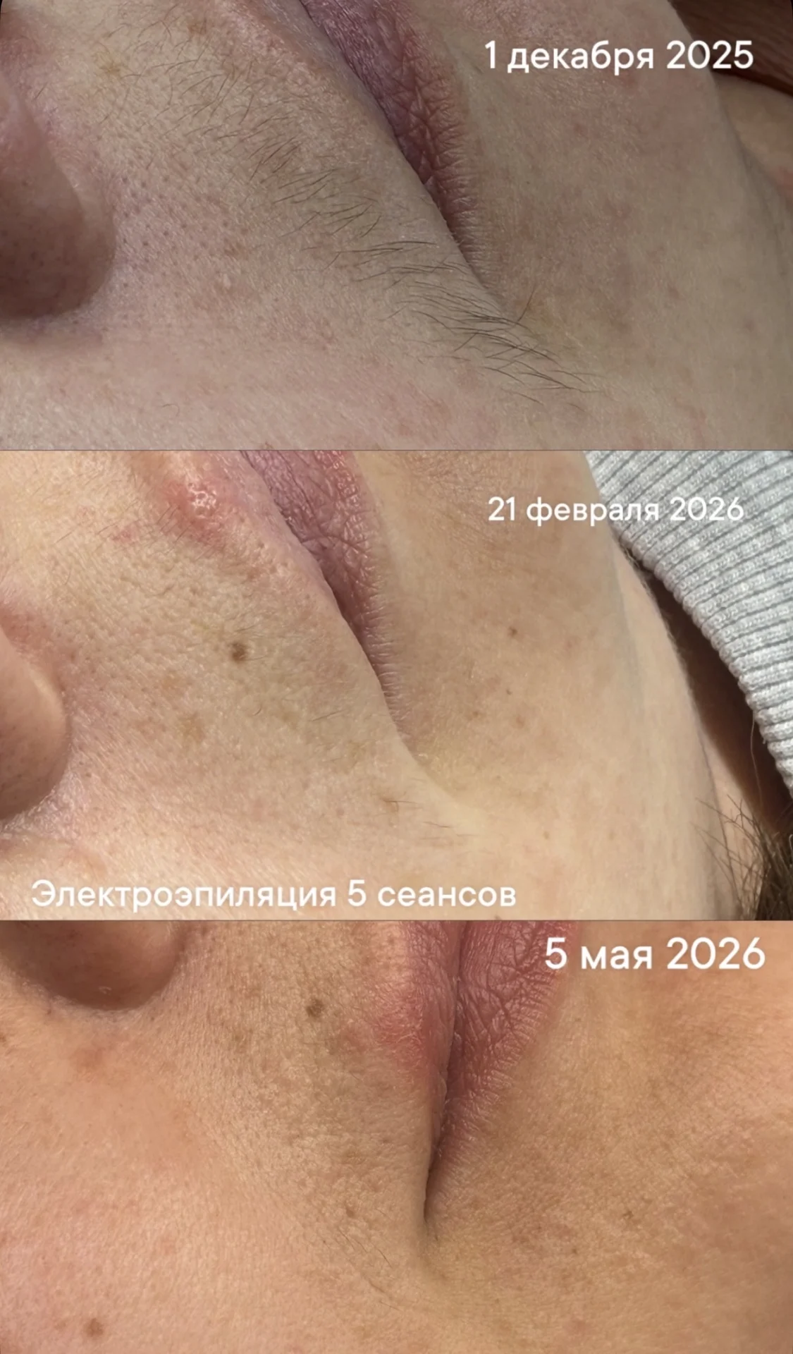 Лазерная и электроэпиляция - миниатюра 6