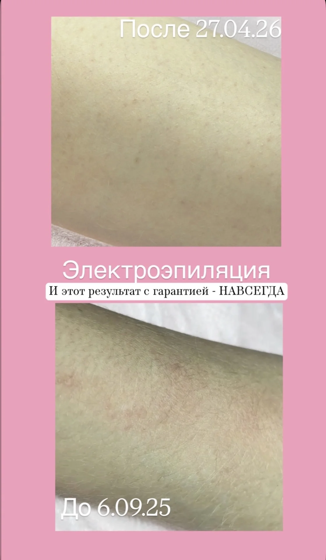 Лазерная и электроэпиляция - миниатюра 7