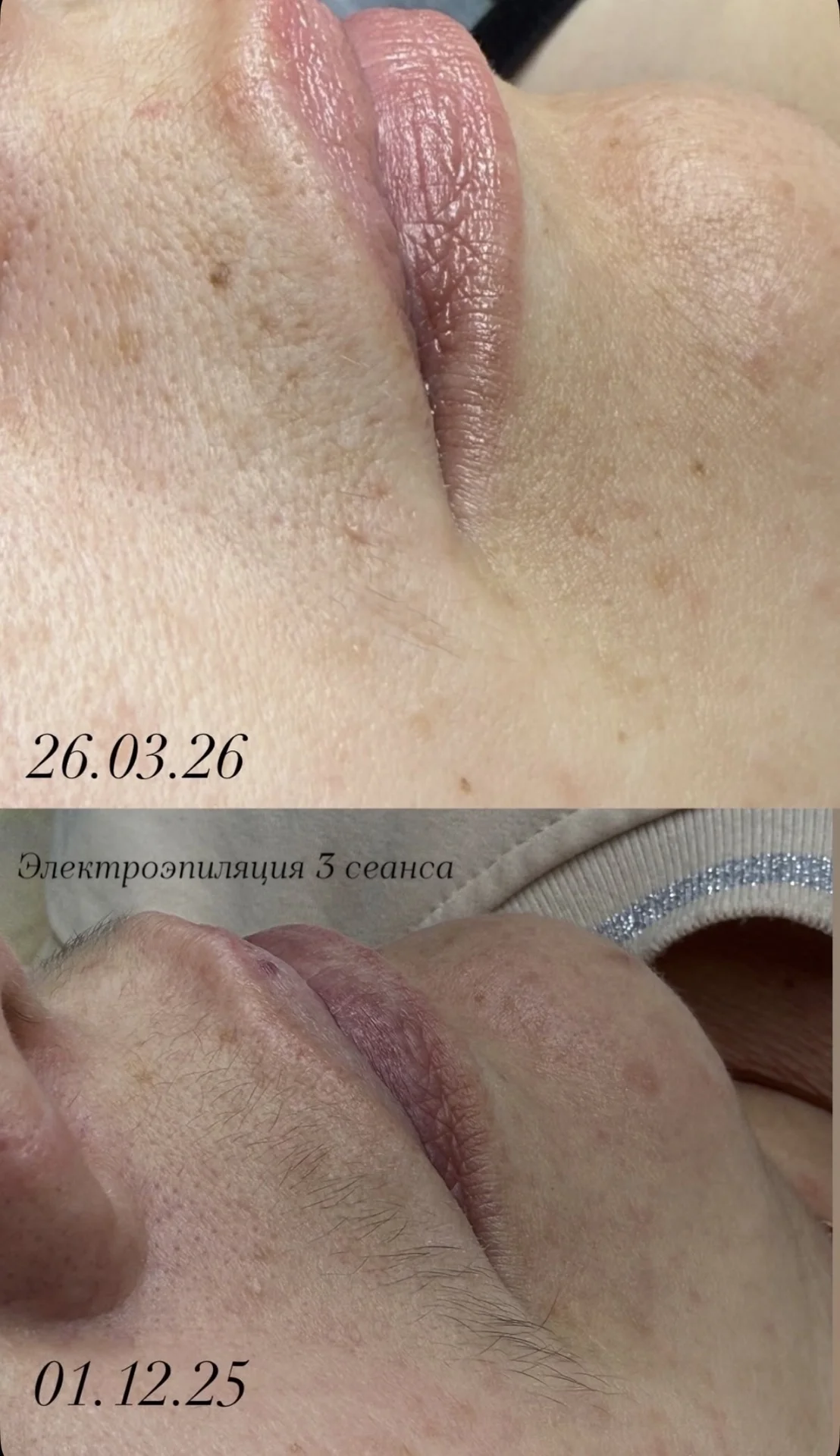 Лазерная и электроэпиляция - миниатюра 9