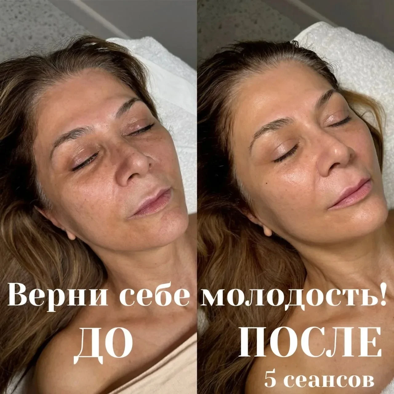 Антивозрастной,косметический аппаратный массаж лица - миниатюра 2