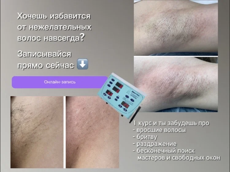 Электроэпиляция Пушкино - изображение 1