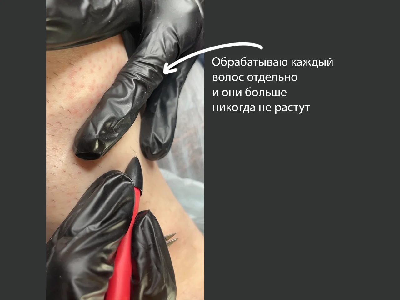 Электроэпиляция модель Малаховка - миниатюра 4