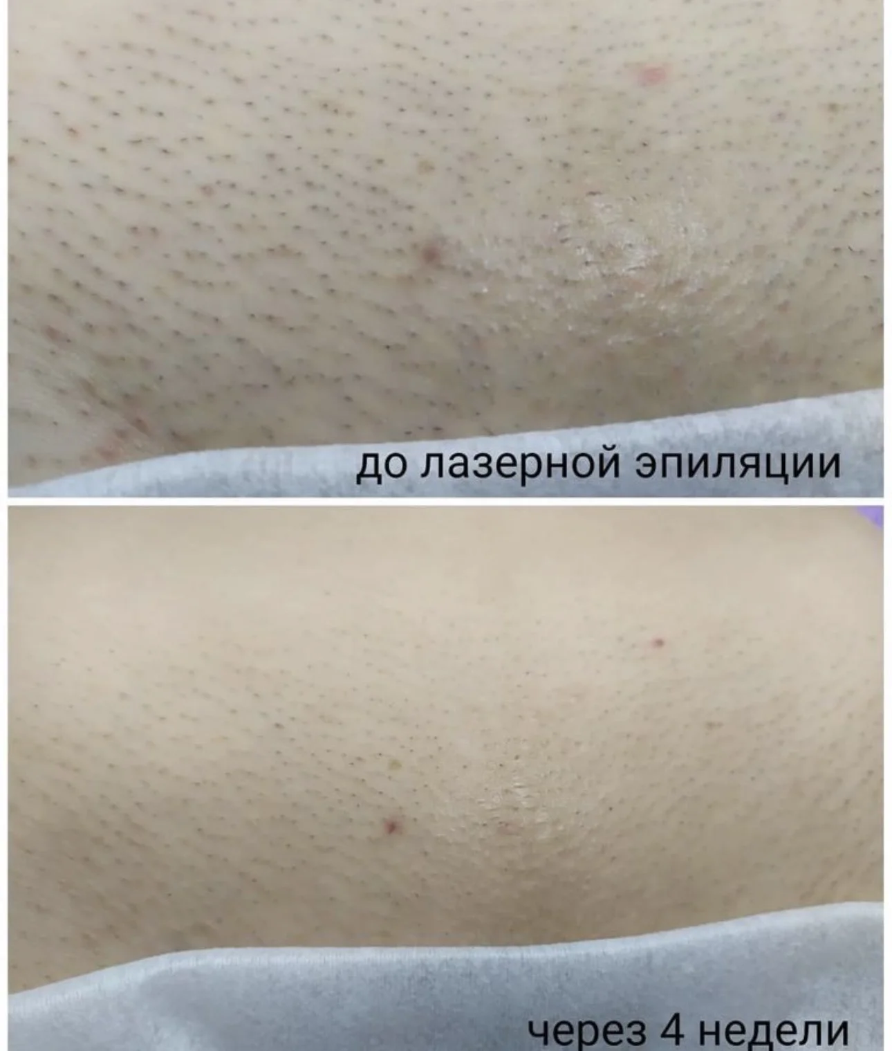 Лазерная эпиляция мощным лазером - миниатюра 3
