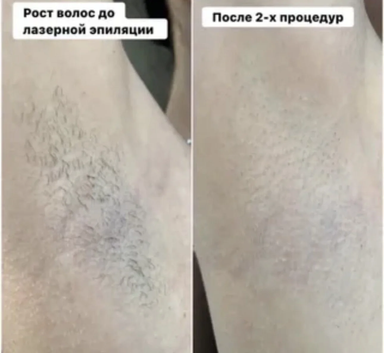 Лазерная эпиляция мощным лазером - миниатюра 5