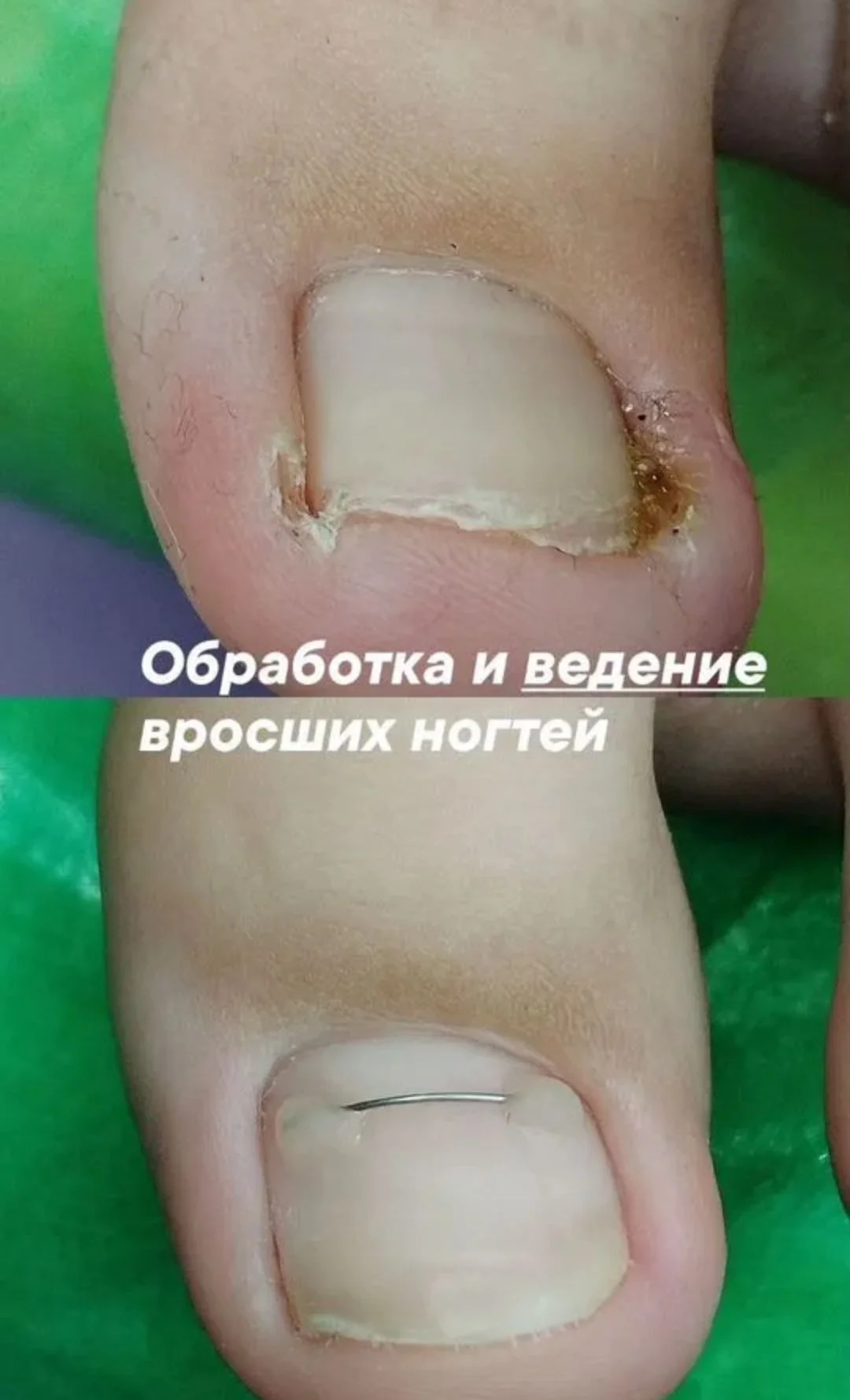 Подолог в кабинете и на дом - миниатюра 4