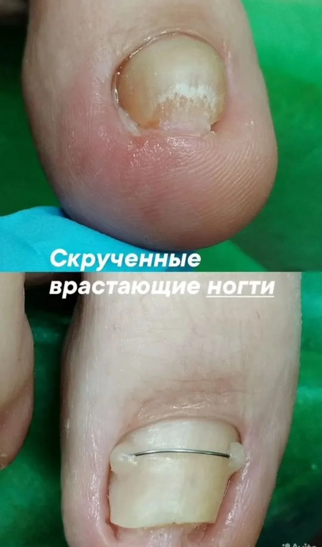 Подолог в кабинете и на дом - миниатюра 6